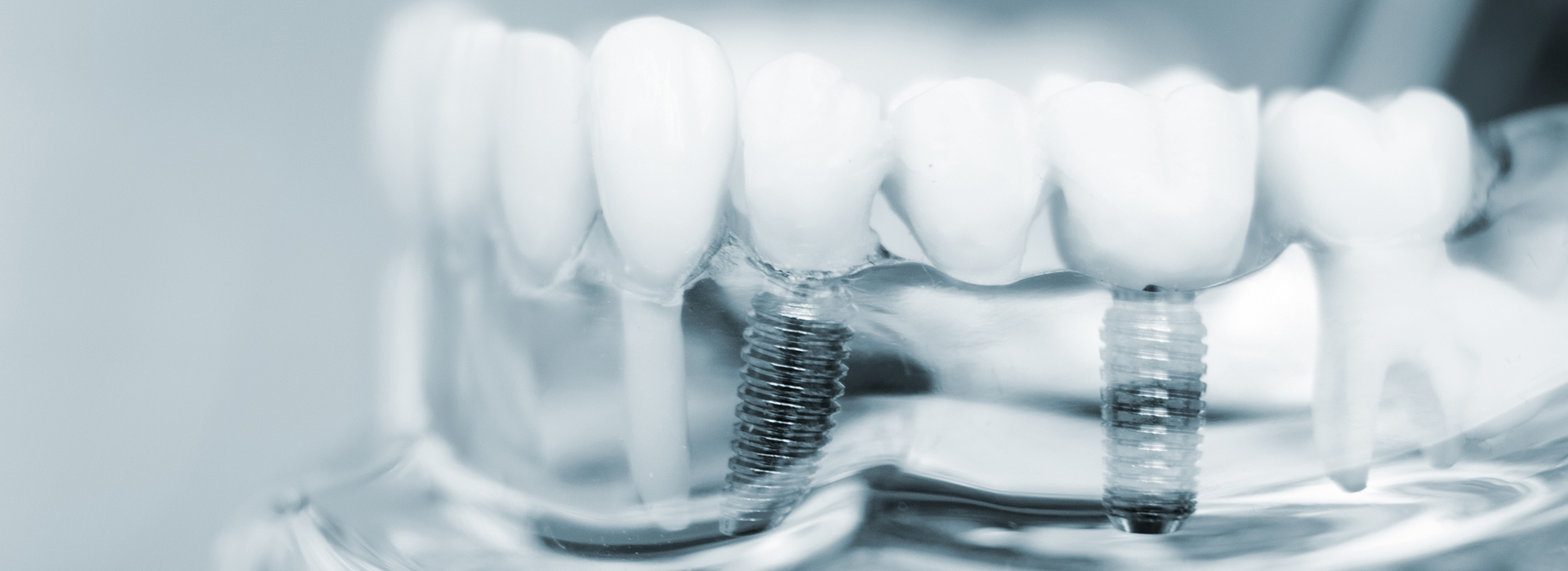 Downtown Parker Dental | Dentures, Sleep Apnea and Cosmetic Bonding