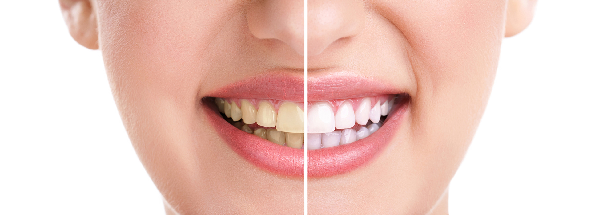Downtown Parker Dental | Dental Fillings, Dentures and ZOOM Whitening